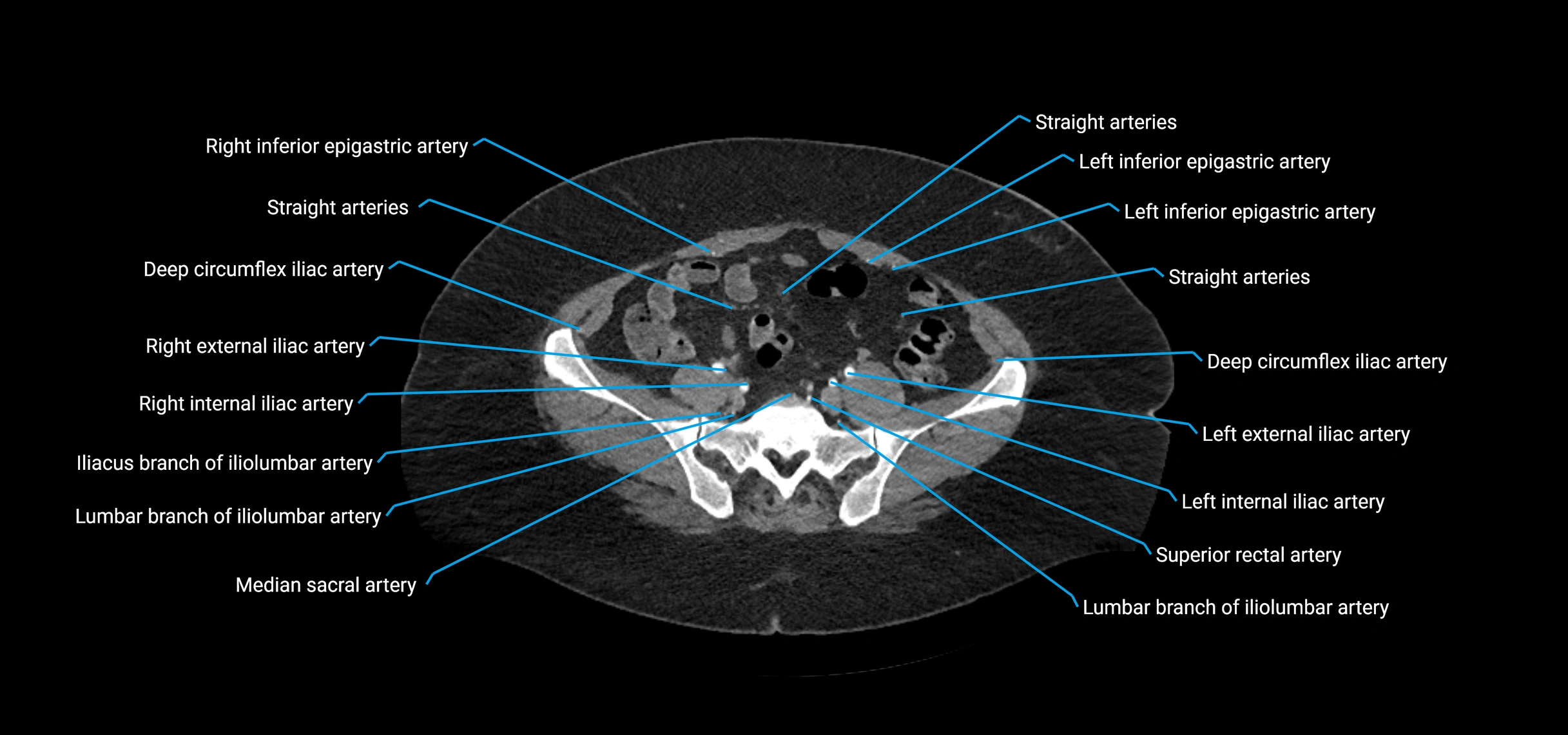CTA abdomen axial cross sectional anatomy labelled image_183 (2).webp